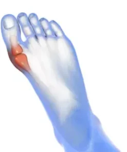 2 PK Sesamoiditis Pad for Sesamoid Pain - Ball of Foot Bunion Relief,